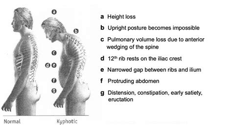 ball compression vertebral test|Osteoporotic Vertebral Compression Fracture.